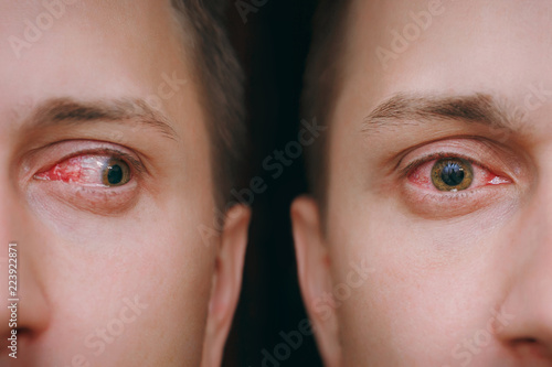 Close up annoyed red blood human male eyes affected by conjunctivitis or after flu cold allergy. Looking camera aside. Disease treatment medicine health concept. Copy space. Workspace mockup template. photo