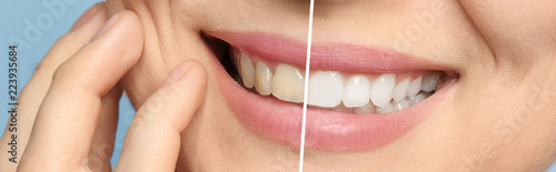 Canvas Print Smiling woman before and after teeth whitening procedure, closeup