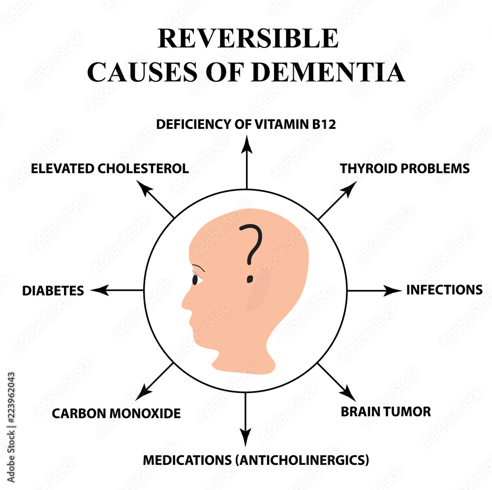 Fototapeta premium Reversible causes of senile dementia. Alzheimer's disease. Infographics. Vector illustration on isolated background