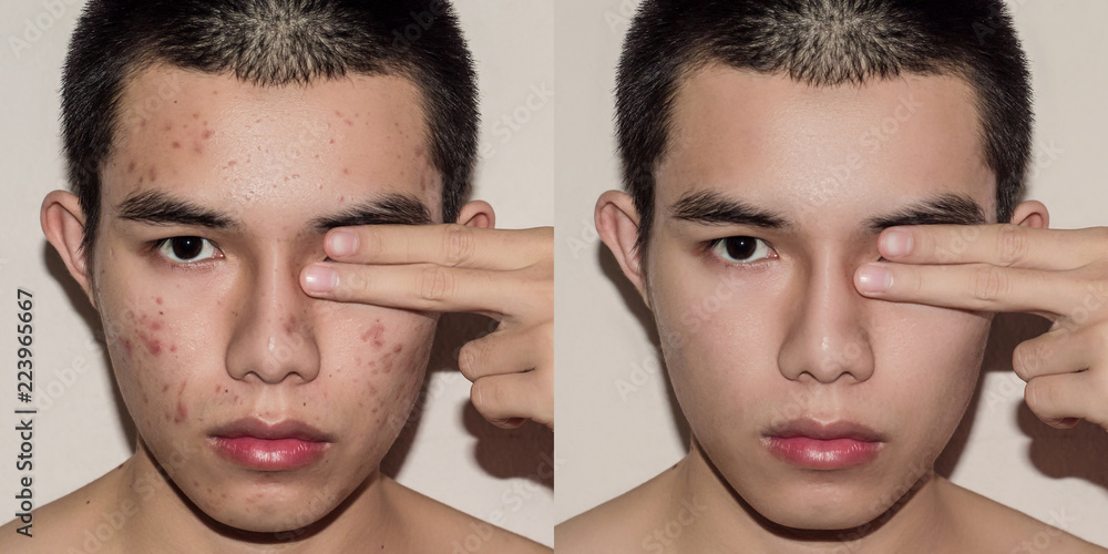 Foto de Young man with before and after treatment from acne and pimple ...