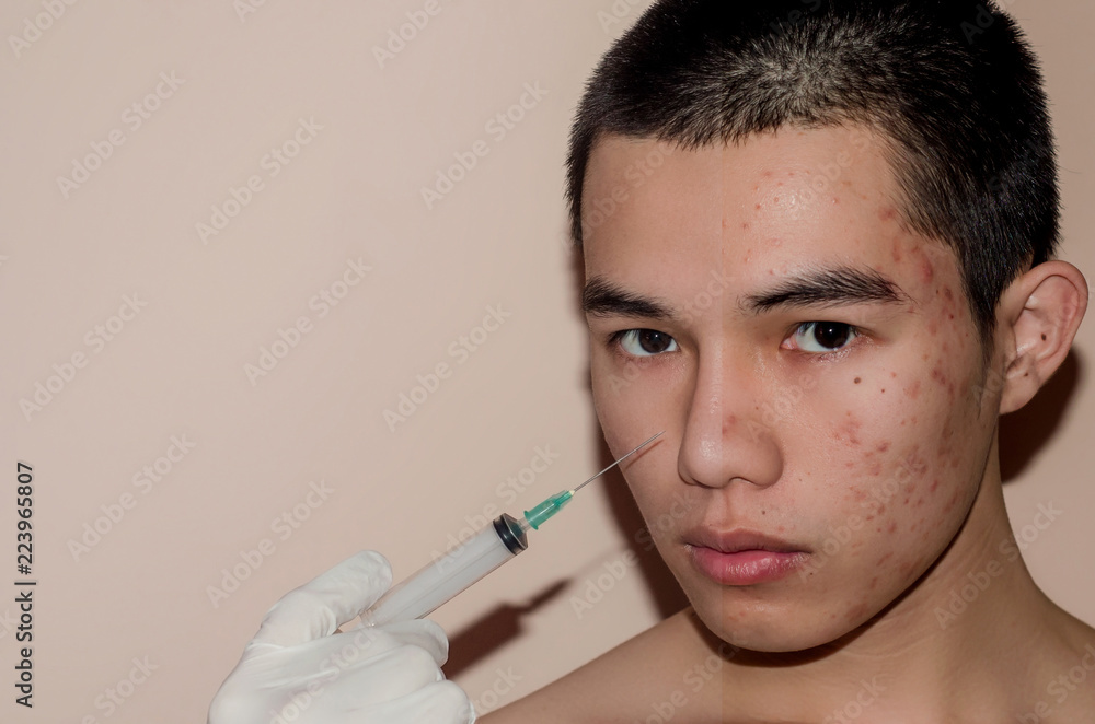 Young man with before and after treatment from acne and pimple by removal acne. Young man with before and after treatment from acne and pimple by removal acne.