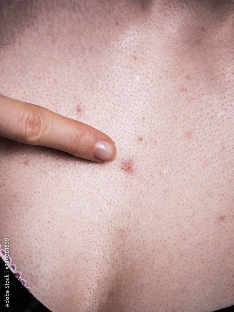 Woman having pimples spots on Stock Photo | Adobe Stock