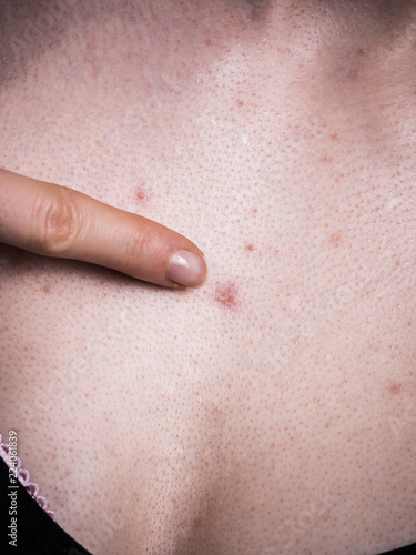 Woman having pimples red spots on chest