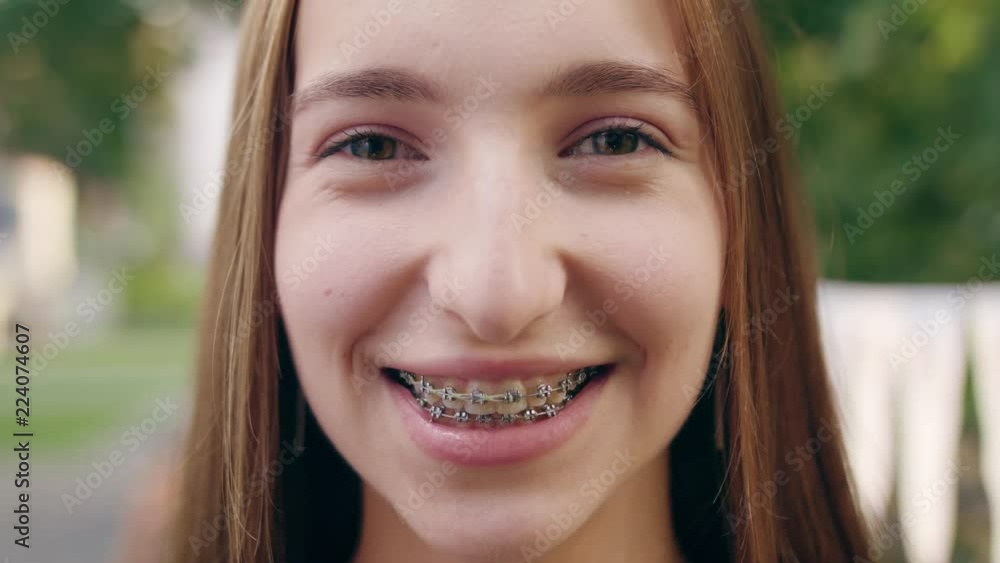 A happy smiling woman wearing braces on her teeth in the city street. Close-up shot. Soft focus A happy smiling woman wearing braces on her teeth in the city street. Close-up shot. Soft focus