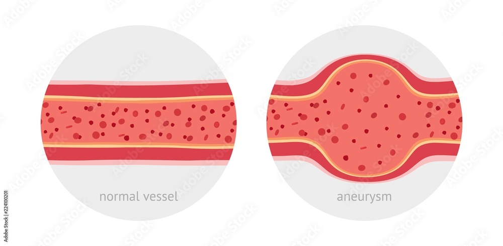 Φωτογραφία Healthy and sick aneurysm human vessel