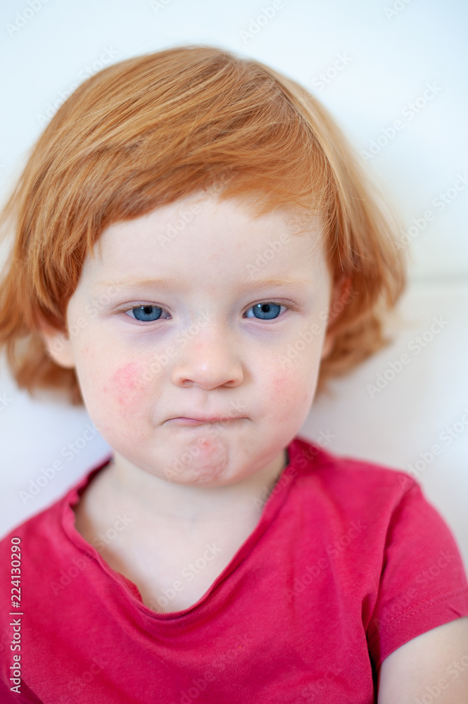 Allergies, atopic dermatitis on the face of a boy