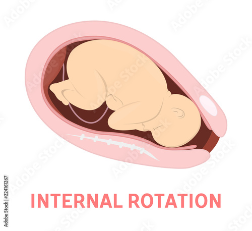Rotation stage of baby birth in vaginal delivery