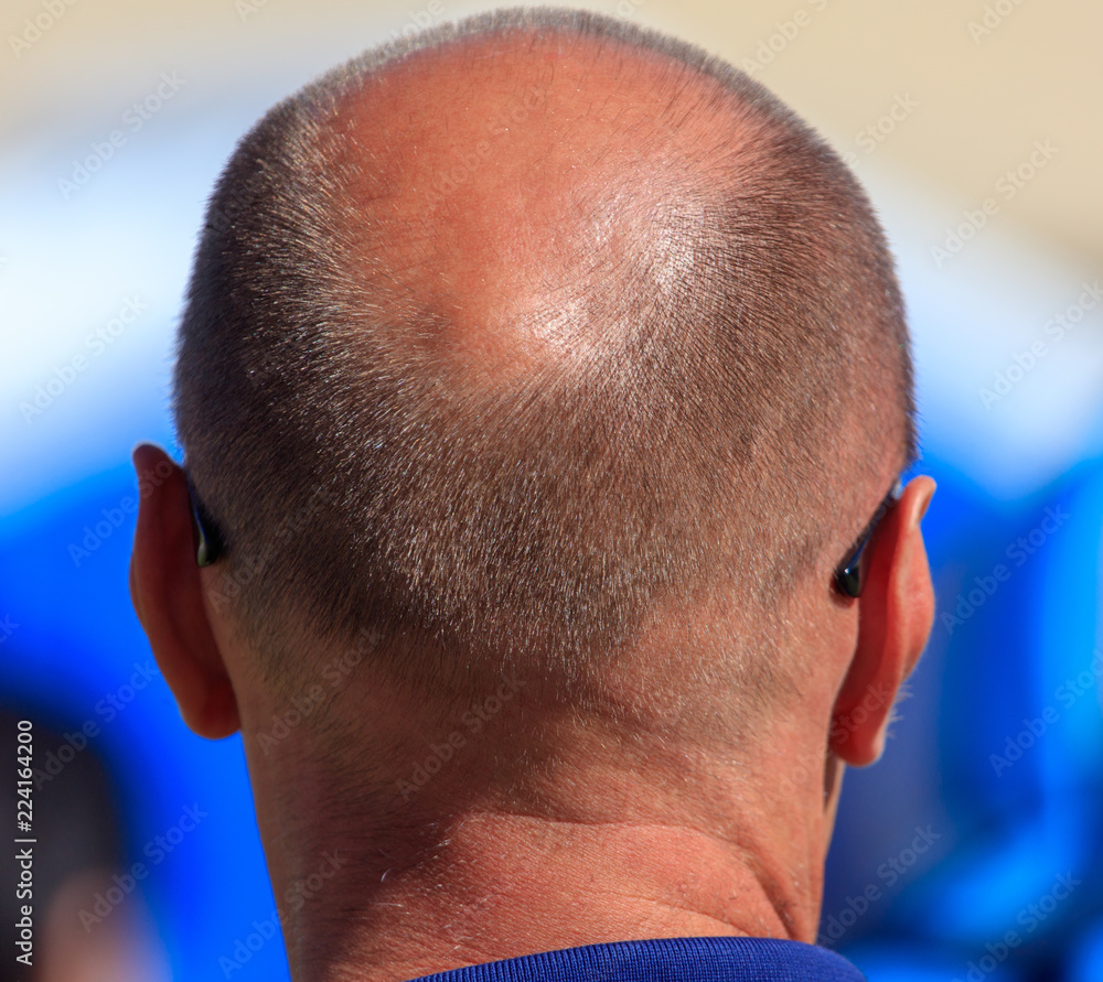Fototapeta premium Hair loss on the head of a man