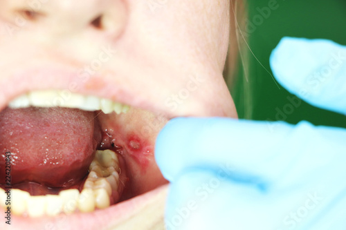 Εκτύπωση καμβά Painful ulcer and stomatitis on the mucous cheek of a girl