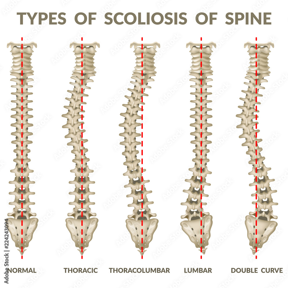 Infographics Types Of Scoliosis Of Spine Body Posture Defect 3d 