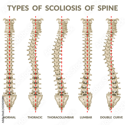 Infographics types of scoliosis of spine. Body posture defect. 3d realistic vector illustration on white background. photo