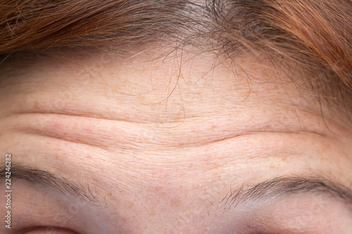 Deep wrinkles in woman forehead