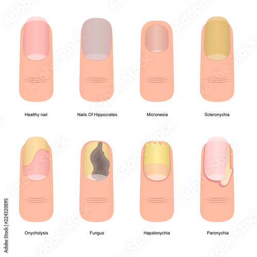 Cartoon Color Nail Diseases Icon Set. Vector