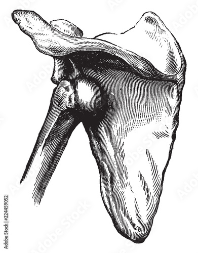 Subspinous Dislocation of the Humerus, vintage illustration.