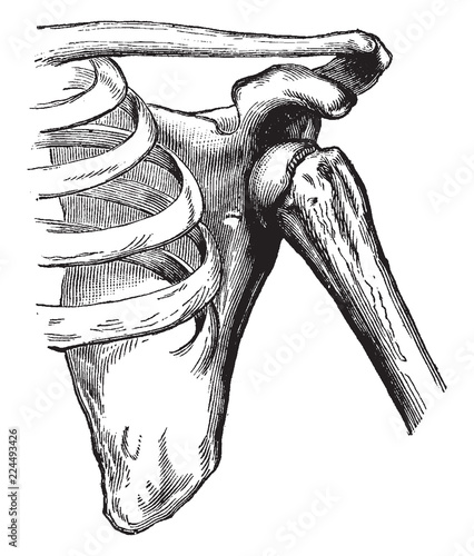 Dislocation of the Humerus, vintage illustration.