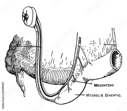 Meckel's Diverticulum, vintage illustration. photo