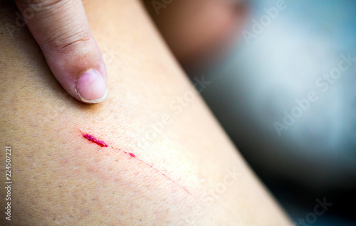 Closed-up of a scratch fresh wounds on shin. concept of Accident  insurance  wound healing in children.