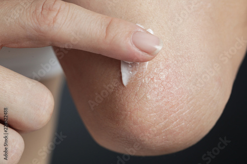 Winterizing dry itchy skin on the elbow area