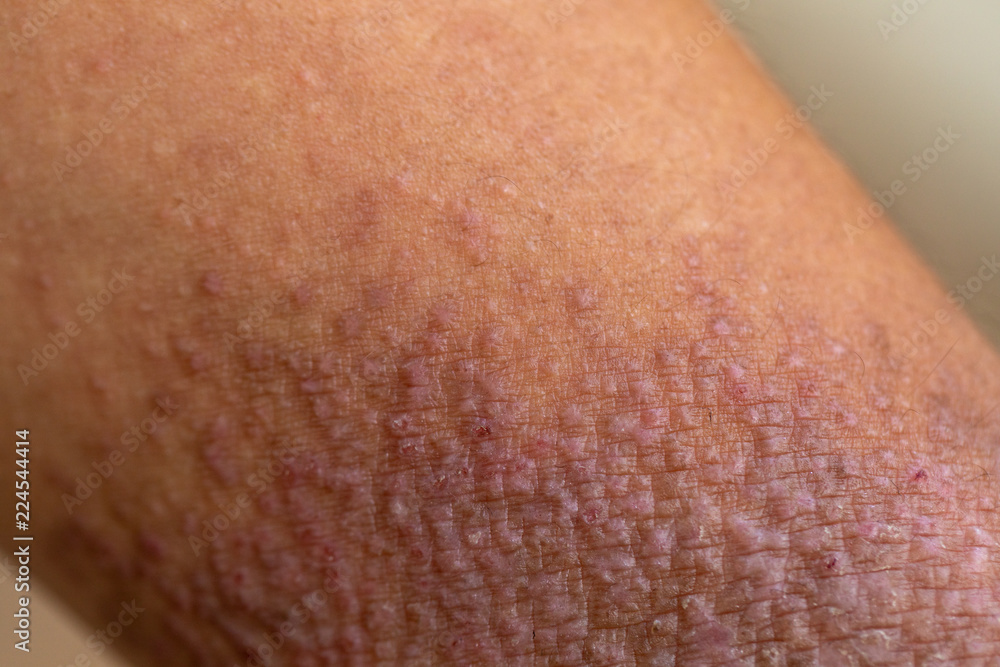 Fototapeta premium A physical of Atopic dermatitis (AD), also known as atopic eczema, is a type of inflammation of the skin (dermatitis).