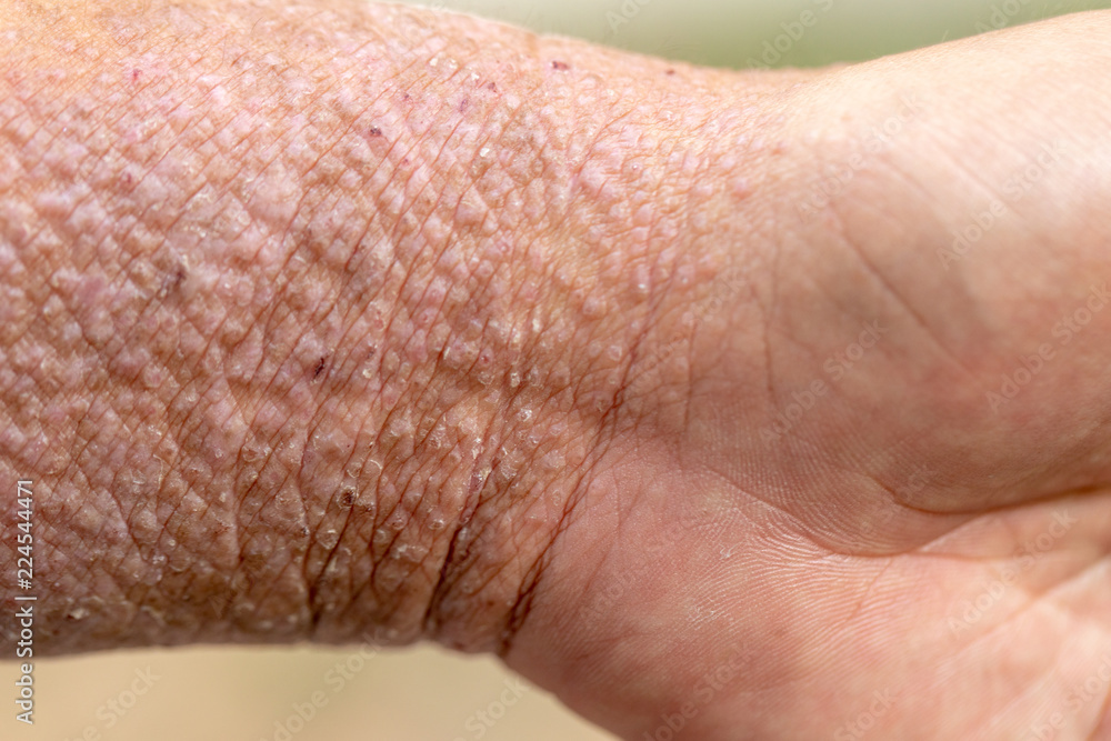 Fototapeta premium A physical of Atopic dermatitis (AD), also known as atopic eczema, is a type of inflammation of the skin (dermatitis).