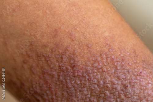 A physical of Atopic dermatitis (AD), also known as atopic eczema, is a type of inflammation of the skin (dermatitis).