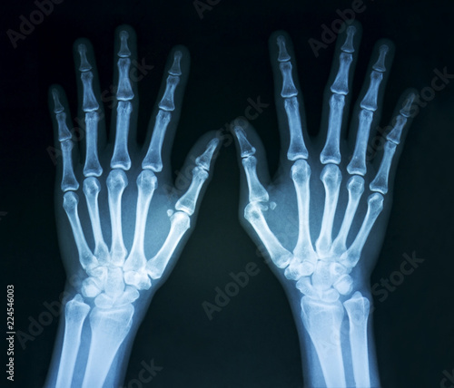 Film x-ray normal both human’s hands