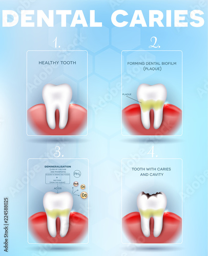 Tooth decay, dental caries formation detailed diagram, dental plaque, loss of calcium, phosphate and finally forms caries and cavity. Beautiful dental poster with abstract light blue background