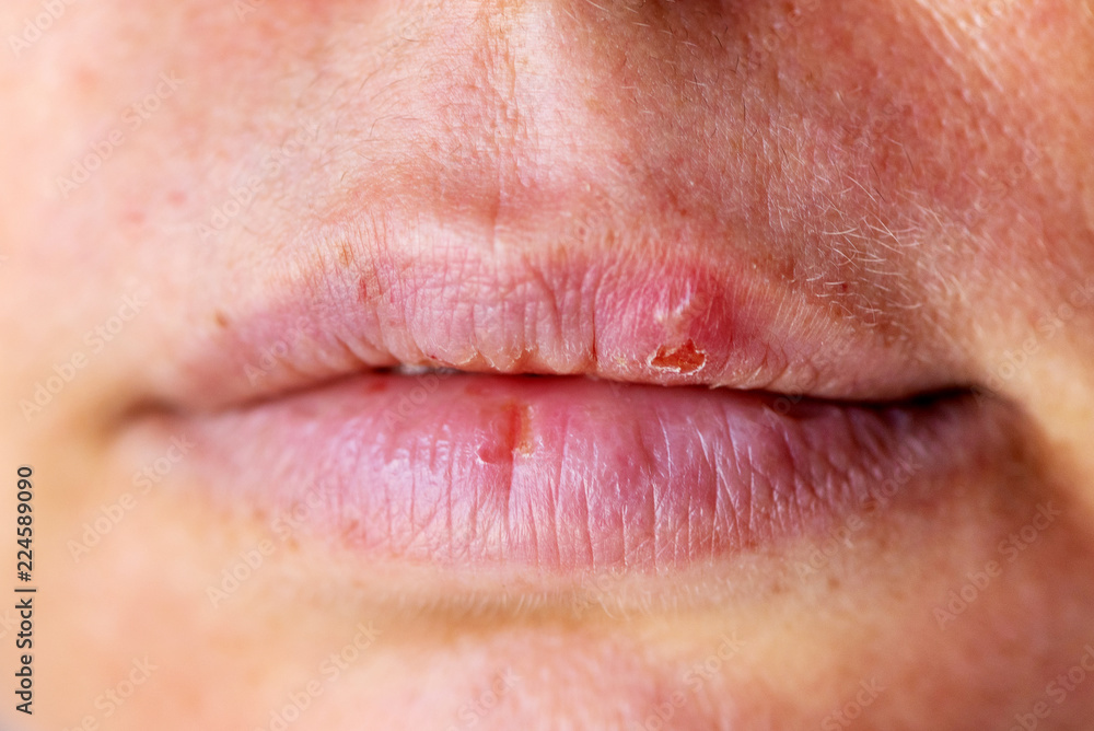 Herpes on the lip close up macro Herpes on the lip close up macro