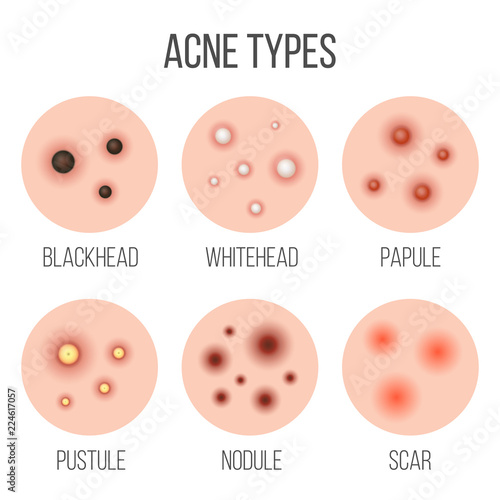 Creative vector illustration types of acne, pimples, skin pores, blackhead, whitehead, scar, comedone, stages diagram isolated on transparent background. Art design . Abstract concept graphic element