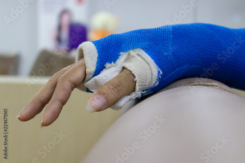 Arm of woman who have got wounded and wearing a splint