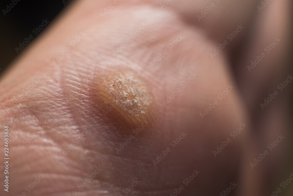 Verruca on hand, wart freeze concept, selective focus Verruca on hand, wart freeze concept, selective focus