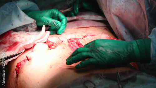 Plastic surgeon performs an operation for abdominoplasty with a transfer of the navel photo