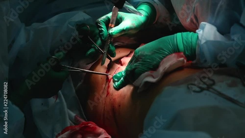 Plastic surgeon performs an operation for abdominoplasty with a transfer of the navel