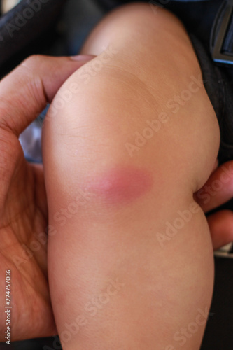 baby's leg with red spot caused by insect bite © NOTE OMG