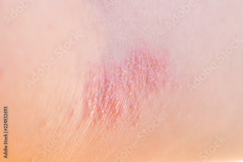 Woman has rash on her arm skin human asian background photo