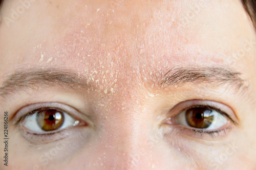 Fényképezés woman with atopic dermatitis