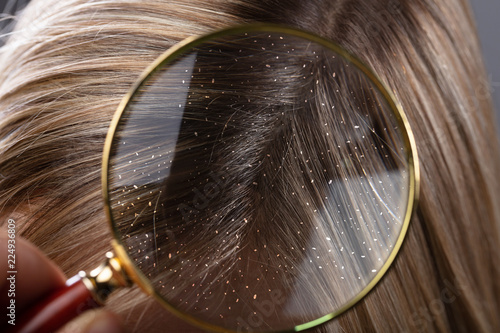 Dandruff In Hair Seen Through Magnifying Glass photo