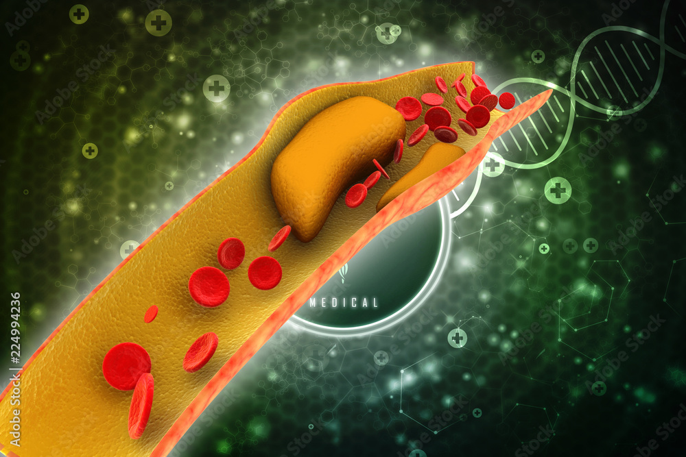 3d rendering blood cells with plaque buildup of cholesterol symbol of ...