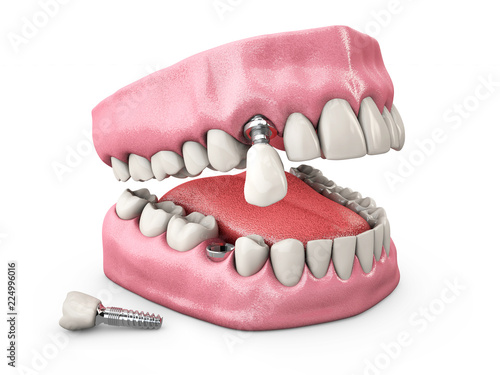 Human teeth and Dental implant. 3d illustration