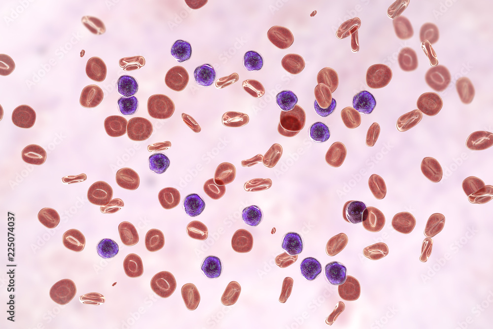 Acute lymphoblastic leukemia Acute lymphoblastic leukemia