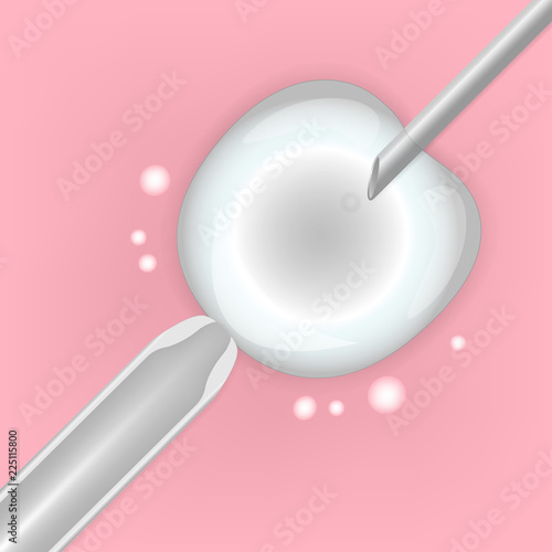 In vitro fertilization