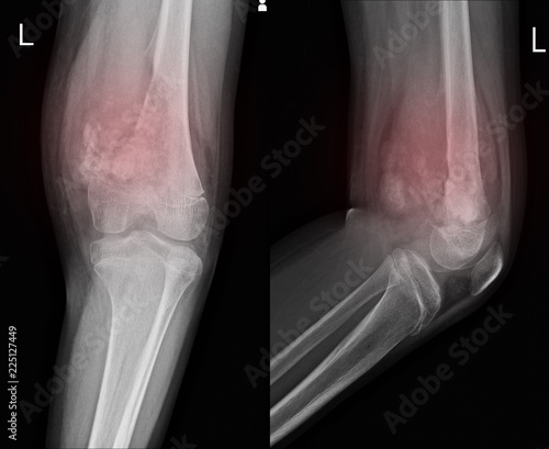 X-ray Knee join Showing large osteolytic lesuion of medial aspect of left distal femur.with soft tissure mass.and malignant bone tumor,osteosarcoma is suspected. photo