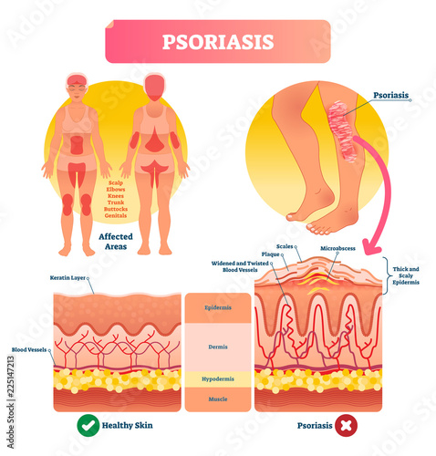 Psoriasis vector illustration. Skin disease and illness. Labeled structure.