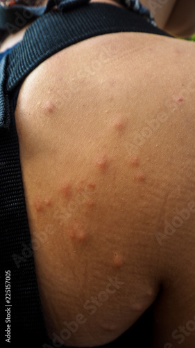 mosquito bites on a shoulder of a woman in the amazon rainforest