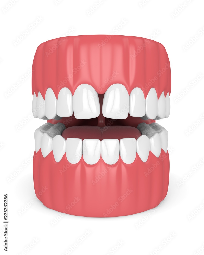 Fototapeta premium 3d render of teeth with convergent diastema