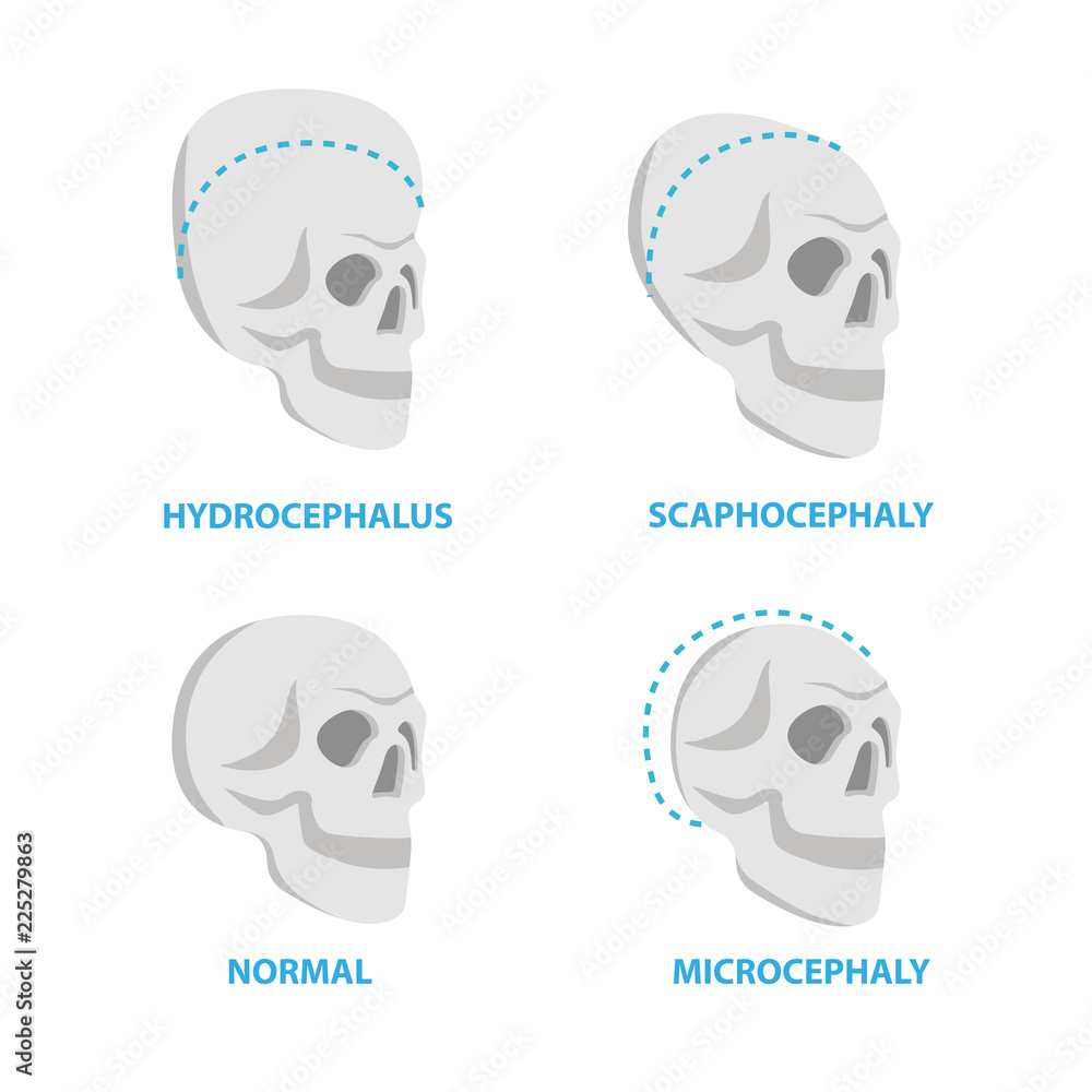 Set of Skulls normal and deformed, hydrocephalus, scaphocephaly, microcephaly vector flat icons, skull medical illustrations, anatomical infographic elements isolated on white background.