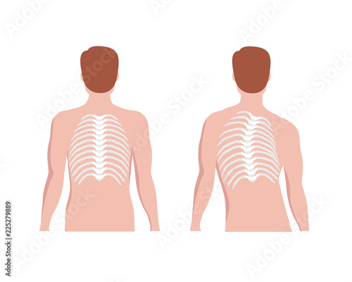 Thoracic Scoliosis on the thoracic spine and straight backbone concept vector illustration in flat design isolated on white background. Scoliosis medical infographic elements, male silhouette