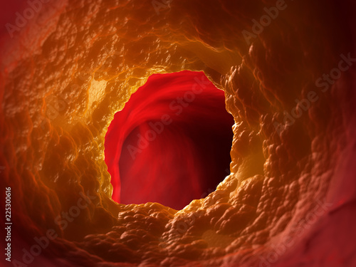 Canvas Print 3d rendered medically accurate illustration of a blocked artery