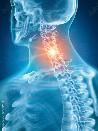 3d rendered medically accurate illustration of a painful cervical spine