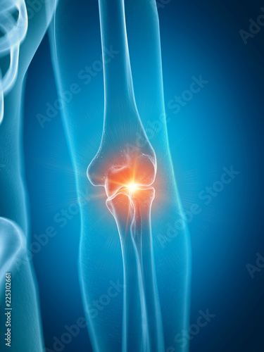 3d rendered medically accurate illustration of a painful elbow joint